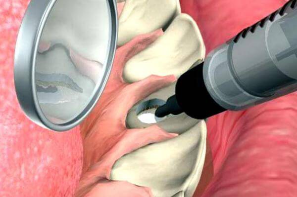 вред от внутриканального отбеливания зубов